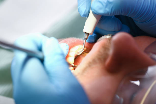 Best Emergency Dentist for Lost Fillings or Crowns in Woodacre, CA